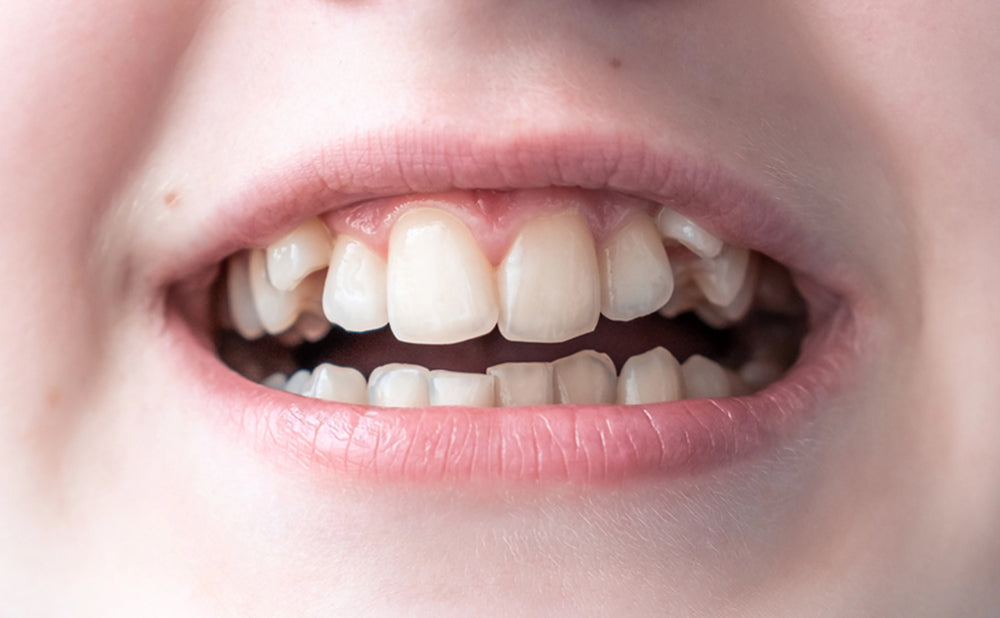 hyperdontia