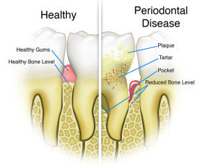 ORAL PROBIOTIC LACTOBACILLUS REUTERI AND CHRONIC PERIODONTITIS