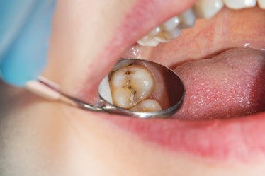 teeth with cavities 