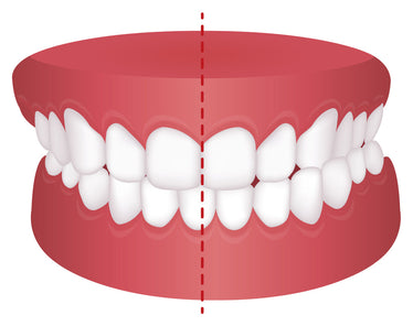 crossbite