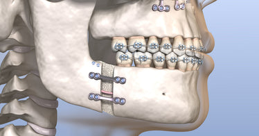 micrognathia jaw 