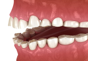 eroded enamel