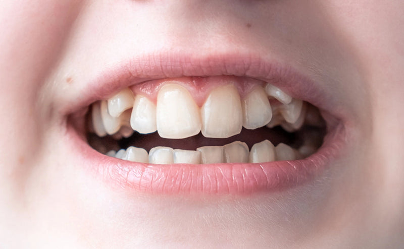 hyperdontia
