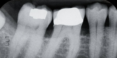 sensitive teeth